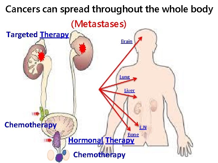 Cancers can spread throughout the whole body Targeted Therapy (Metastases) Brain Lung Liver Chemotherapy