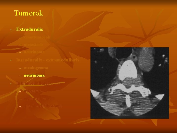 Tumorok • • • Extraduralis – csonttumorok – metastasis – neurinoma Intraduralis - extramedullaris