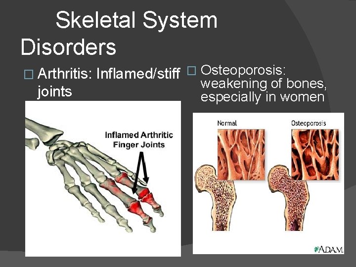 Skeletal System Disorders � Arthritis: joints Inflamed/stiff � Osteoporosis: weakening of bones, especially in