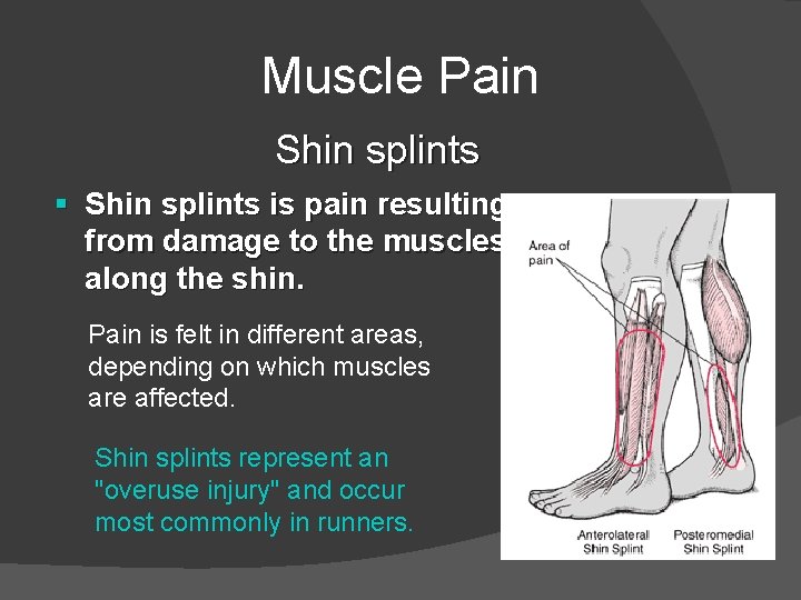 Muscle Pain Shin splints § Shin splints is pain resulting from damage to the