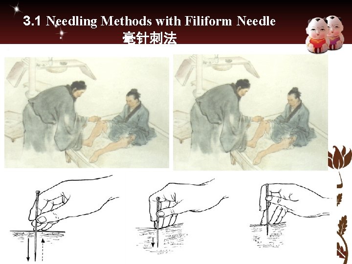 3. 1 Needling Methods with Filiform Needle 毫针刺法 