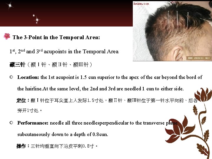 The 3 -Point in the Temporal Area: 1 st, 2 nd and 3 rd The 3 -Point in the Temporal Area: 1 st, 2 nd and 3 rd