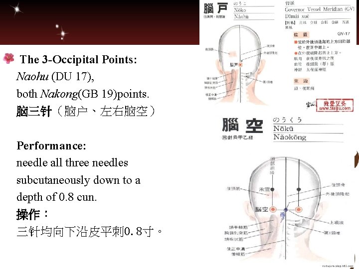  The 3 -Occipital Points: Naohu (DU 17), both Nakong(GB 19)points. 脑三针（脑户、左右脑空） Performance: needle