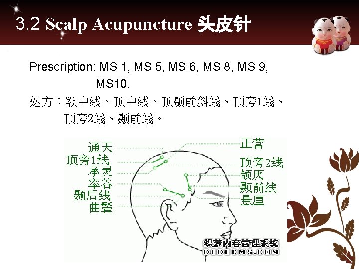 3. 2 Scalp Acupuncture 头皮针 Prescription: MS 1, MS 5, MS 6, MS 8,