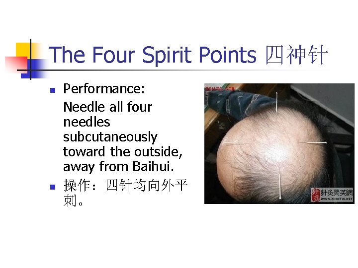 The Four Spirit Points 四神针 n n Performance: Needle all four needles subcutaneously toward