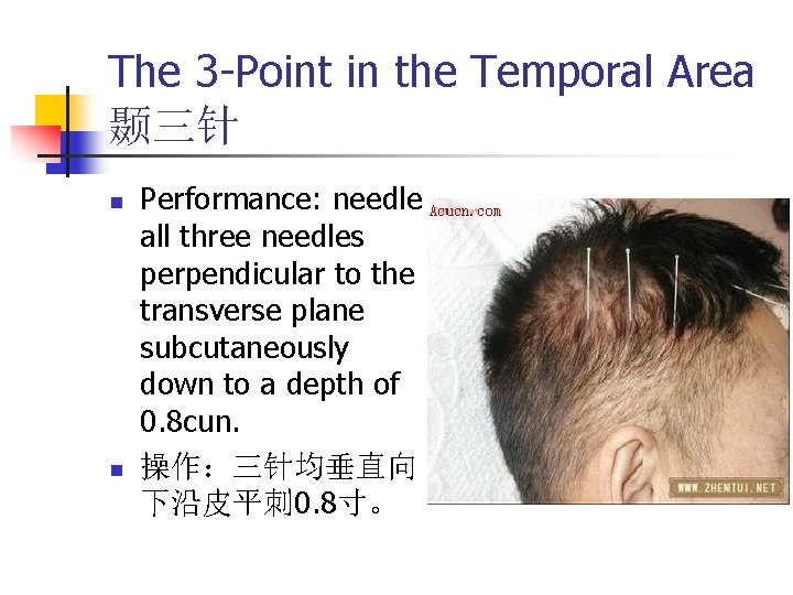 The 3 -Point in the Temporal Area 颞三针 n n Performance: needle all three