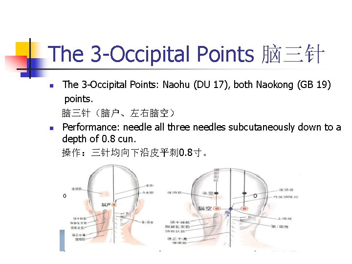 The 3 -Occipital Points 脑三针 n n The 3 -Occipital Points: Naohu (DU 17),