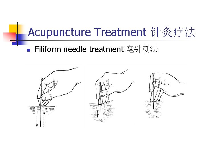 Acupuncture Treatment 针灸疗法 n Filiform needle treatment 毫针刺法 