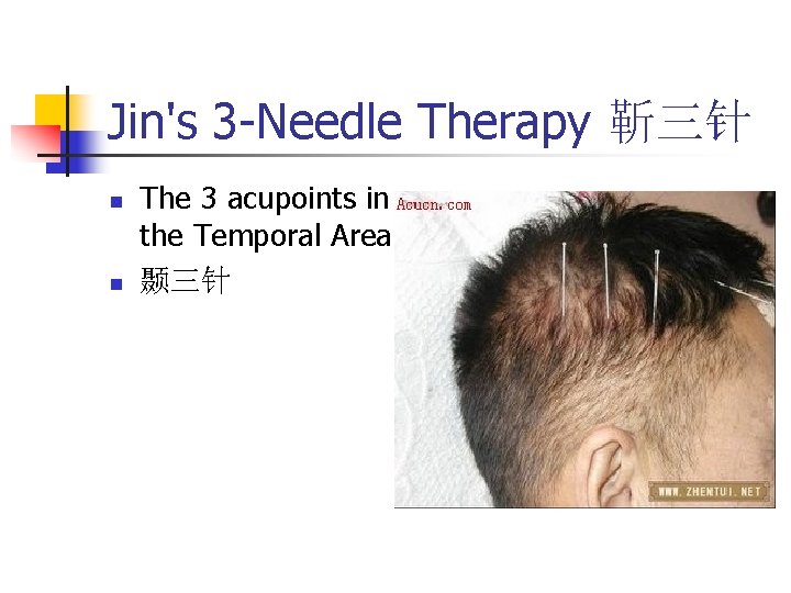 Jin's 3 -Needle Therapy 靳三针 n n The 3 acupoints in the Temporal Area