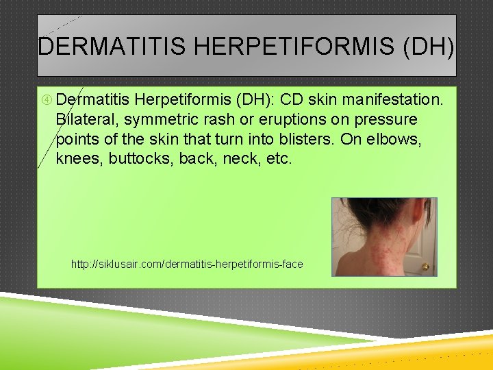 DERMATITIS HERPETIFORMIS (DH) Dermatitis Herpetiformis (DH): CD skin manifestation. Bilateral, symmetric rash or eruptions