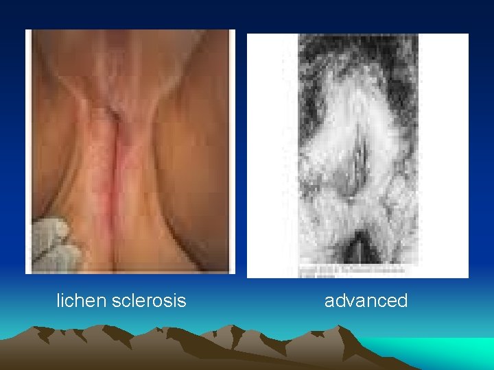 lichen sclerosis advanced 