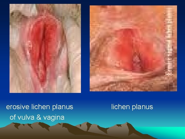 erosive lichen planus of vulva & vagina lichen planus 