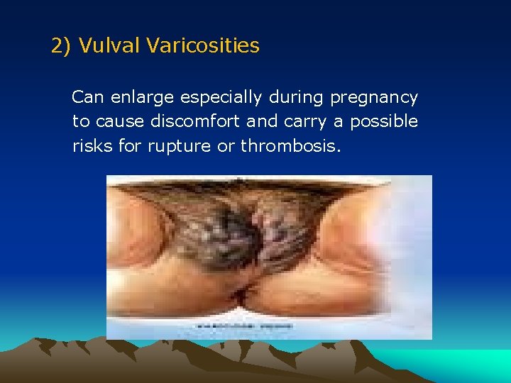 2) Vulval Varicosities Can enlarge especially during pregnancy to cause discomfort and carry a