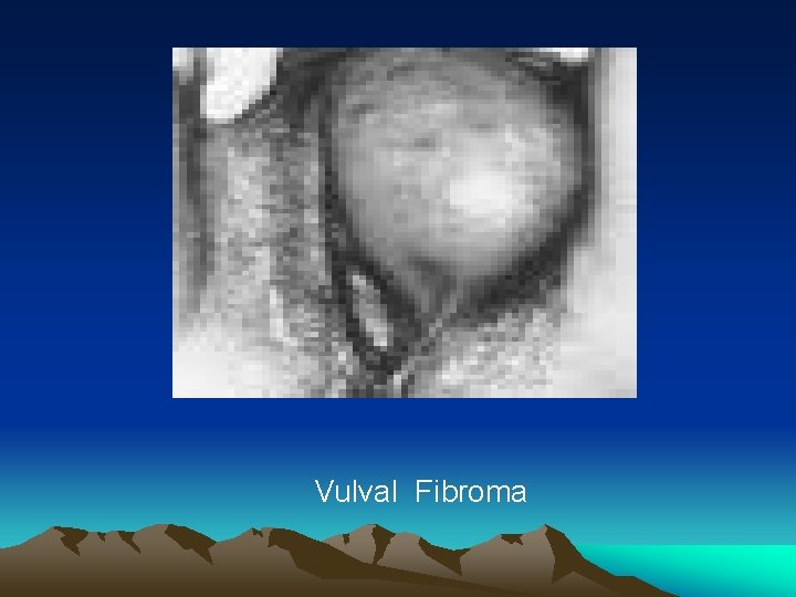 Vulval Fibroma 