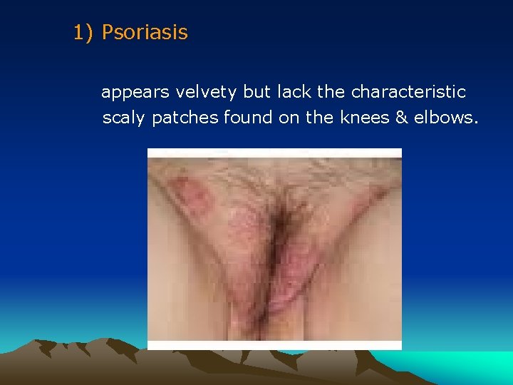 1) Psoriasis appears velvety but lack the characteristic scaly patches found on the knees