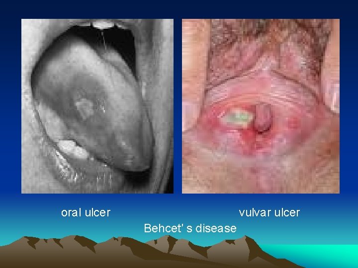 oral ulcer vulvar ulcer Behcet′ s disease 