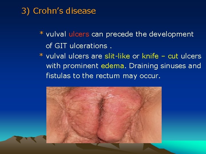 3) Crohn’s disease * vulval ulcers can precede the development of GIT ulcerations. *