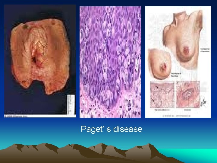 Paget′ s disease 