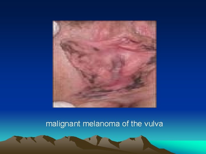 malignant melanoma of the vulva 