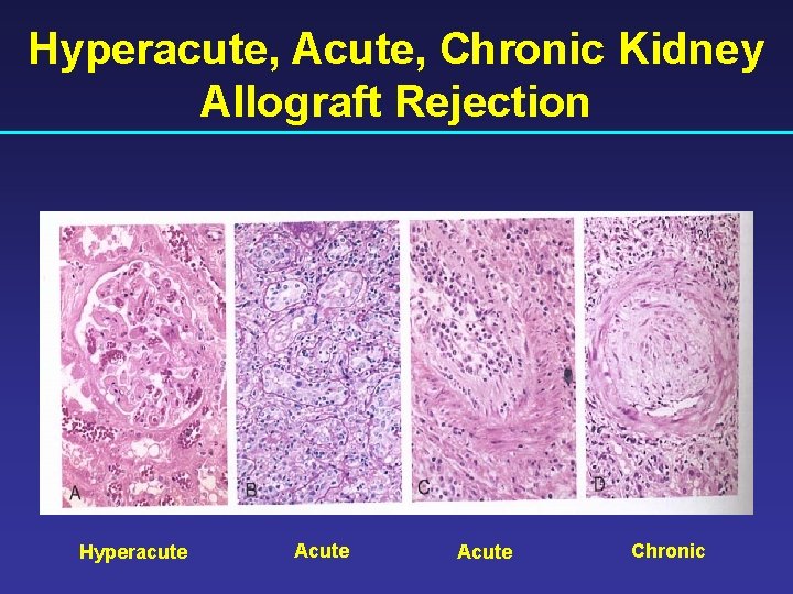 Hyperacute, Acute, Chronic Kidney Allograft Rejection Hyperacute Acute Chronic 