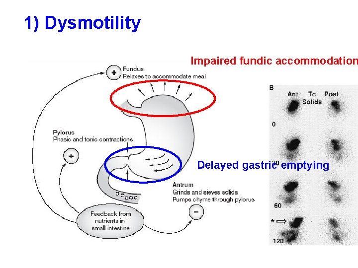 1) Dysmotility Impaired fundic accommodation Delayed gastric emptying 