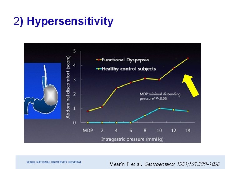 2) Hypersensitivity Mearin F et al. Gastroenterol 1991; 101: 999– 1006 