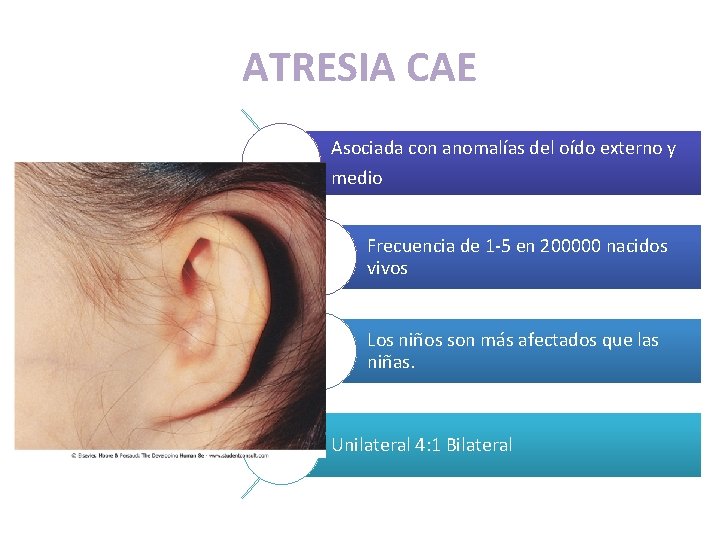 ATRESIA CAE Asociada con anomalías del oído externo y medio Frecuencia de 1 -5