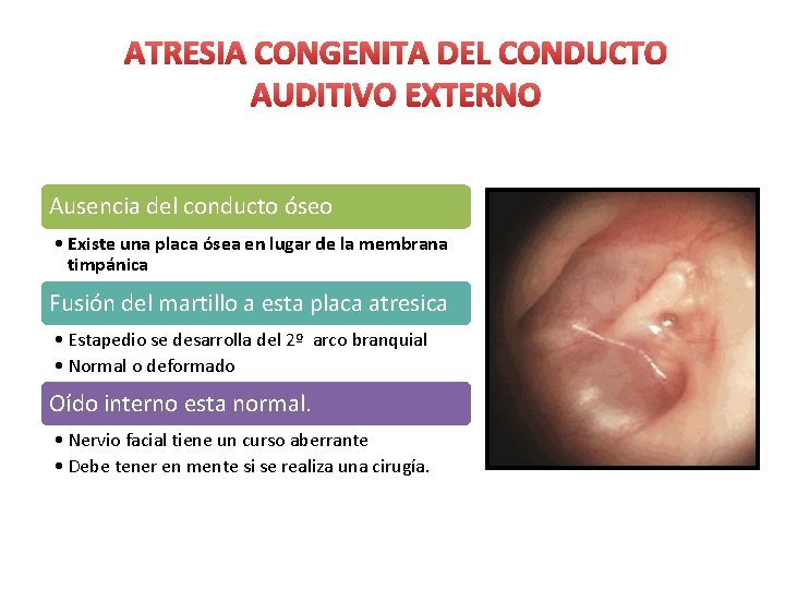 ATRESIA CONGENITA DEL CONDUCTO AUDITIVO EXTERNO Ausencia del conducto óseo • Existe una placa