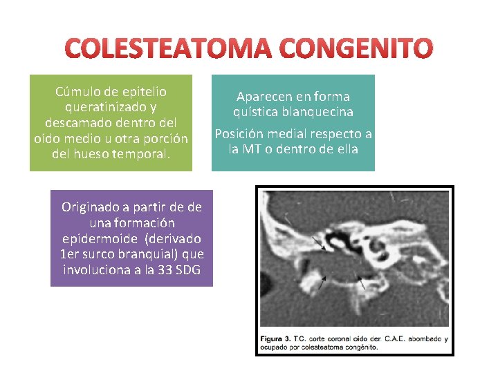 COLESTEATOMA CONGENITO Cúmulo de epitelio queratinizado y descamado dentro del oído medio u otra