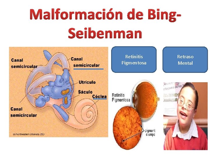 Malformación de Bing. Seibenman Retinitis Pigmentosa Retraso Mental 