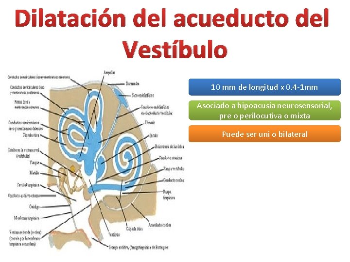 Dilatación del acueducto del Vestíbulo 10 mm de longitud x 0. 4 -1 mm