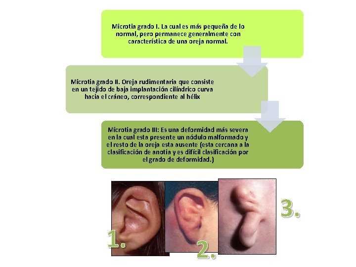 Microtia grado I. La cual es más pequeña de lo normal, pero permanece generalmente