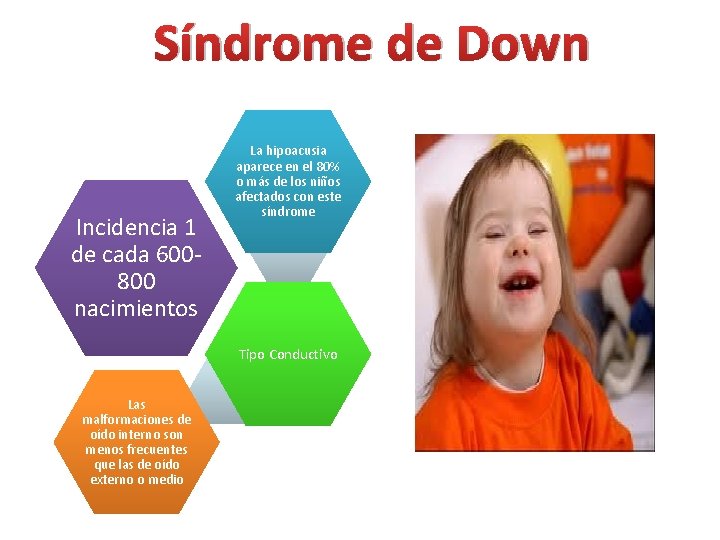 Síndrome de Down Incidencia 1 de cada 600800 nacimientos La hipoacusia aparece en el