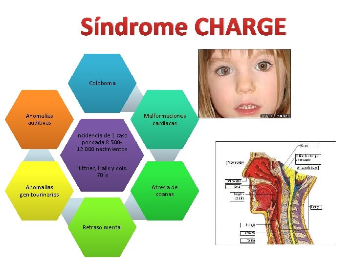 Síndrome CHARGE Coloboma Anomalías auditivas Malformaciones cardiacas Incidencia de 1 caso por cada 8.