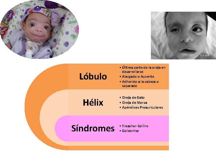 Lóbulo Hélix Síndromes • Última parte de la oreja en desarrollarse • Alargado o