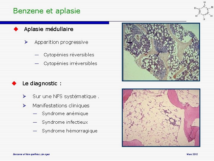 Benzene et aplasie Aplasie médullaire Apparition progressive ― Cytopénies réversibles ― Cytopénies irréversibles Le