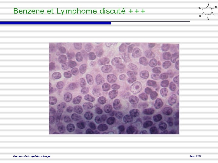 Benzene et Lymphome discuté +++ Benzene et hémopathies, Limoges Mars 2012 