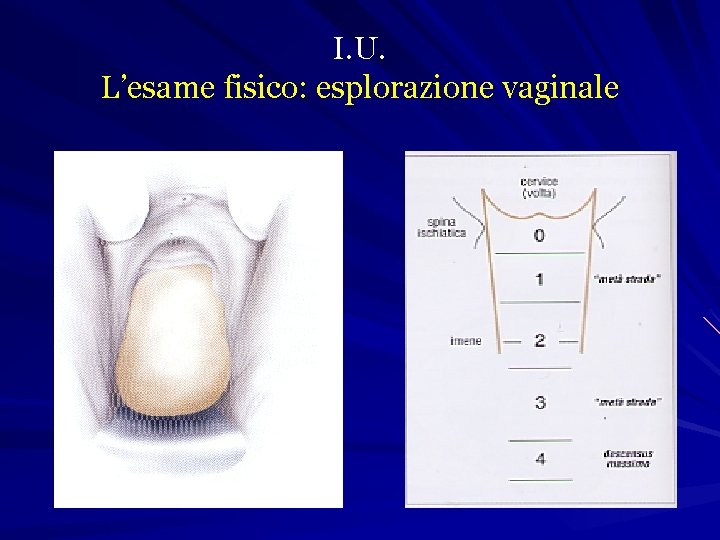 I. U. L’esame fisico: esplorazione vaginale 