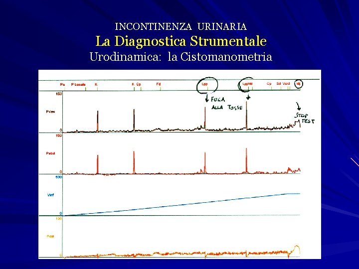 INCONTINENZA URINARIA La Diagnostica Strumentale Urodinamica: la Cistomanometria 