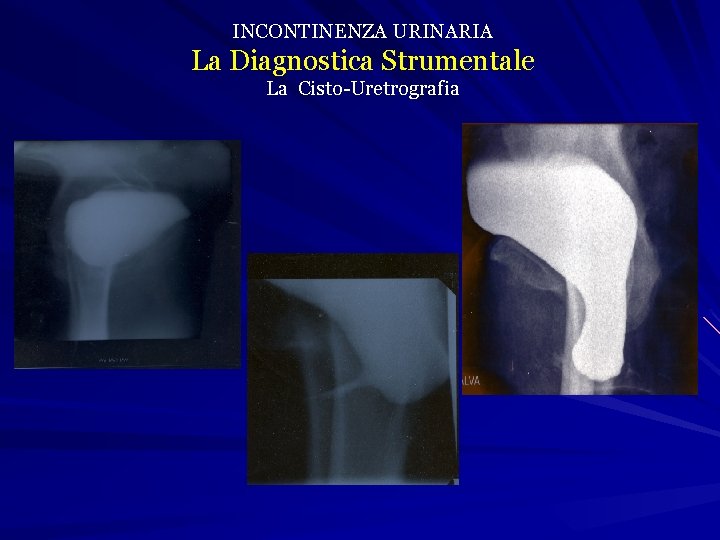 INCONTINENZA URINARIA La Diagnostica Strumentale La Cisto-Uretrografia 