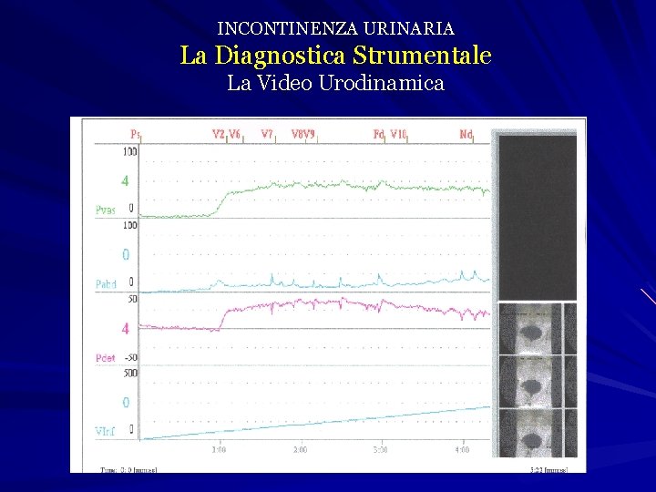 INCONTINENZA URINARIA La Diagnostica Strumentale La Video Urodinamica 