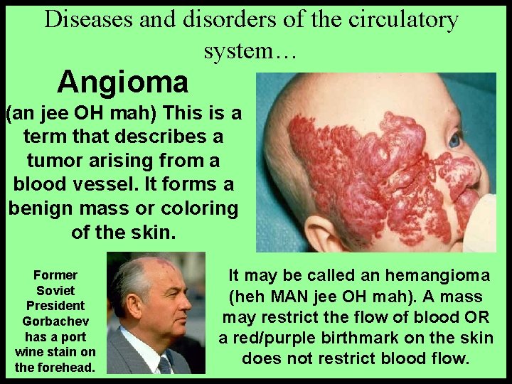 Diseases and disorders of the circulatory system… Angioma (an jee OH mah) This is