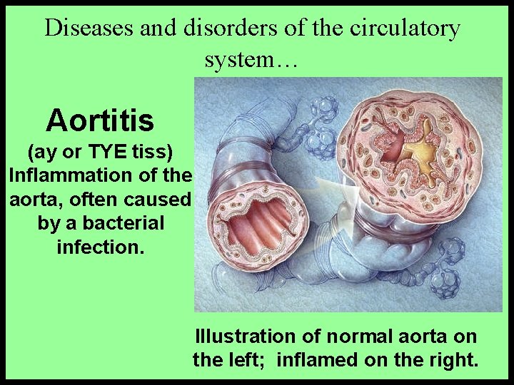 Diseases and disorders of the circulatory system… Aortitis (ay or TYE tiss) Inflammation of
