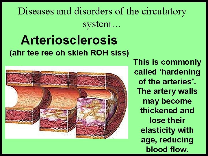 Diseases and disorders of the circulatory system… Arteriosclerosis (ahr tee ree oh skleh ROH