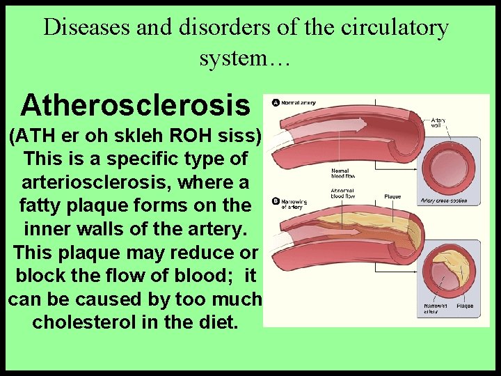 Diseases and disorders of the circulatory system… Atherosclerosis (ATH er oh skleh ROH siss)