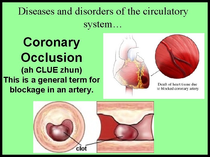 Diseases and disorders of the circulatory system… Coronary Occlusion (ah CLUE zhun) This is