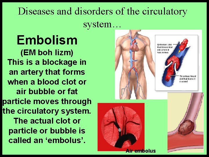 Diseases and disorders of the circulatory system… Embolism (EM boh lizm) This is a