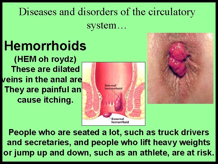 Diseases and disorders of the circulatory system… Hemorrhoids (HEM oh roydz) These are dilated