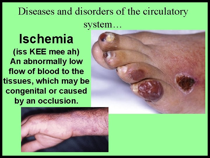 Diseases and disorders of the circulatory system… Ischemia (iss KEE mee ah) An abnormally