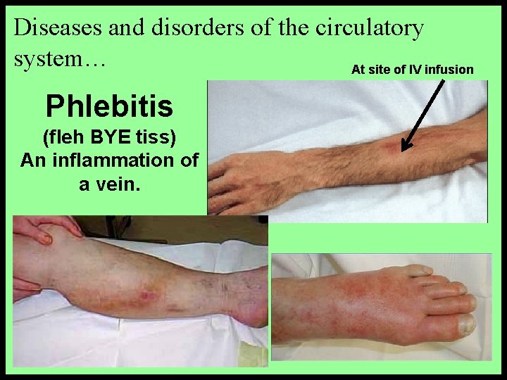 Diseases and disorders of the circulatory system… At site of IV infusion Phlebitis (fleh